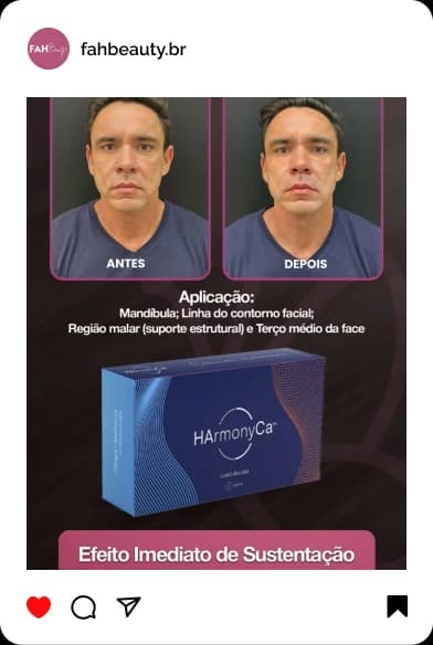 Armonização Facial em Araçatuba