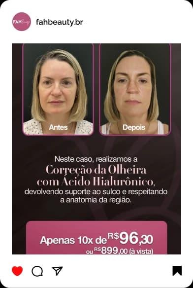 Armonização Facial em Araçatuba