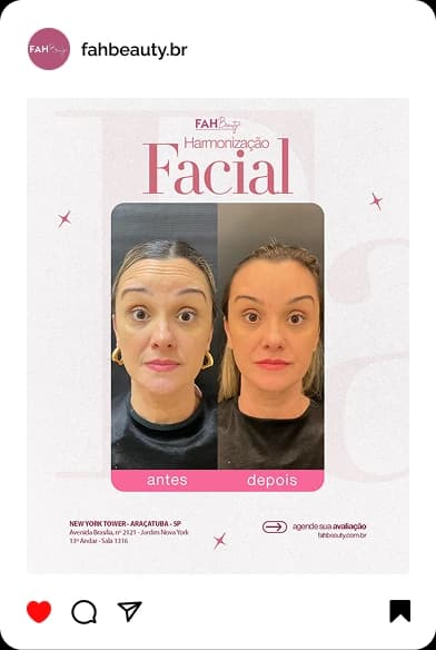 Armonização Facial em Araçatuba