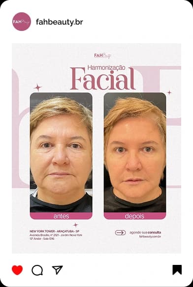 Armonização Facial em Araçatuba