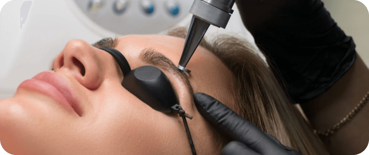 Remoção a Laser de Micropigmentação em araçatuba