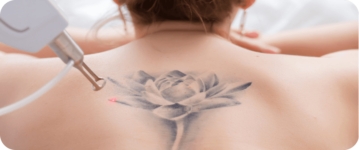 Remoção de Tatuagem em araçatuba