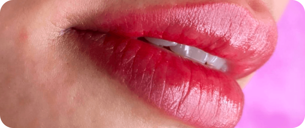 Revitalização Labial em araçatuba